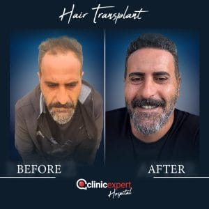 Resultado de injerto capilar DHI-pro en Estambul antes y despues