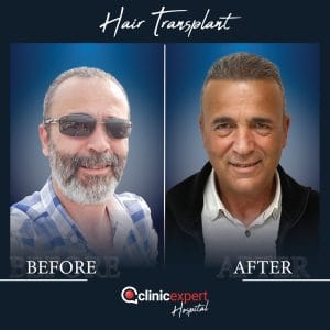 Resultado de injerto capilar DHI-pro en Estambul antes y despues