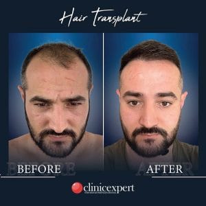 Resultado de injerto capilar DHI-pro en Estambul antes y despues