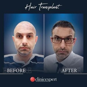 Resultado de injerto capilar DHI-pro en Estambul antes y despues