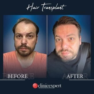 Resultado de injerto capilar DHI-pro en Estambul antes y despues