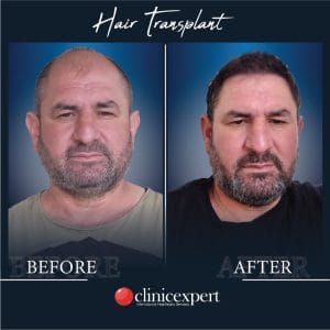 Resultado de injerto capilar DHI-pro en Estambul antes y despues
