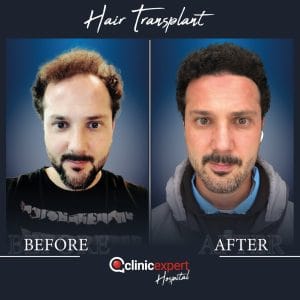 Resultado de injerto capilar DHI-pro en Estambul antes y despues