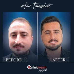 Resultado de injerto capilar DHI-pro en Estambul antes y despues