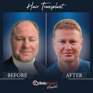 Resultado de injerto capilar DHI-pro en Estambul antes y despues