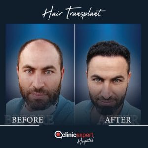 Resultado de injerto capilar DHI-pro en Estambul antes y despues