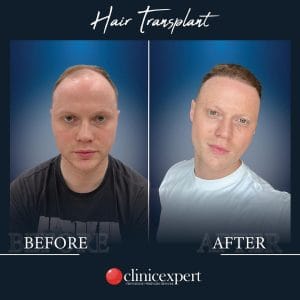 Resultado de injerto capilar DHI-pro en Estambul antes y despues
