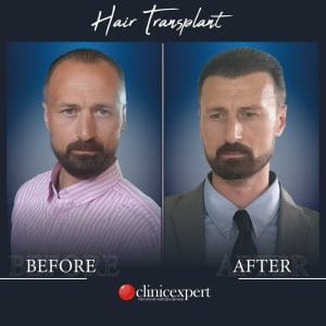 Resultado de injerto capilar DHI-pro en Estambul antes y despues