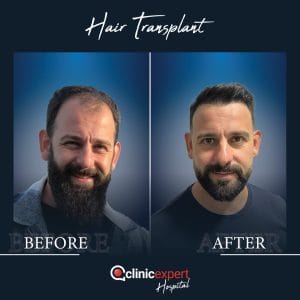 Resultado de injerto capilar DHI-pro en Estambul antes y despues