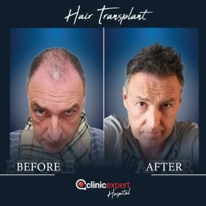 Resultado de injerto capilar DHI-pro en Estambul antes y despues