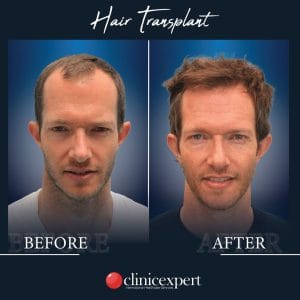 Resultado de injerto capilar DHI-pro en Estambul antes y despues