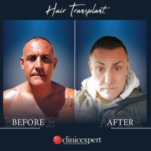 Resultado de injerto capilar DHI-pro en Estambul antes y despues