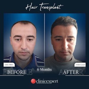 Resultado de injerto capilar DHI-pro en Estambul antes y despues