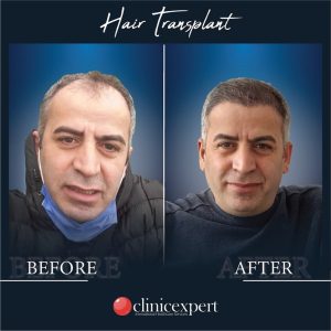 Resultado de injerto capilar DHI-pro en Estambul antes y despues