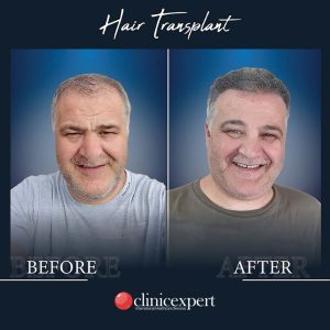 Resultado de injerto capilar DHI-pro en Estambul antes y despues
