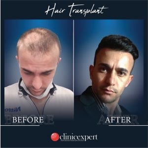Resultado de injerto capilar DHI-pro en Estambul antes y despues