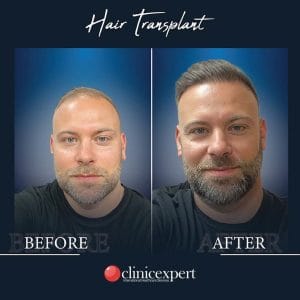 Resultado de injerto capilar DHI-pro en Estambul antes y despues
